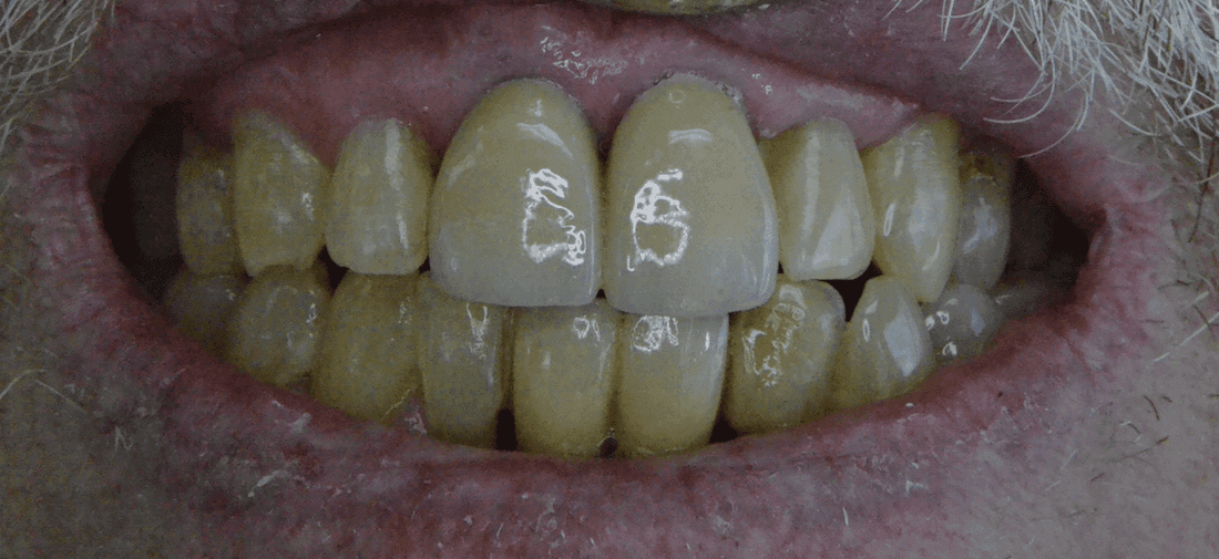 As a result of Crowns, Implants & Esthetic Excellence