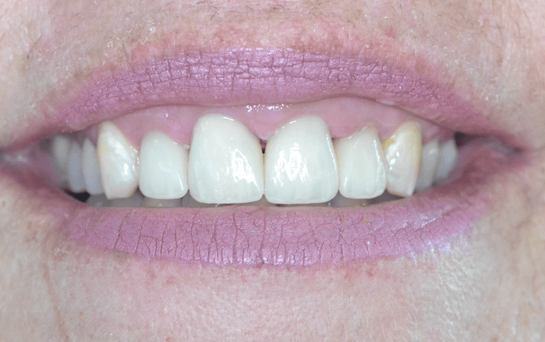 results of Crown Treatment & Esthetic Enhancements in Columbia, MD