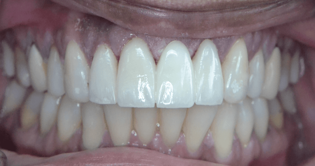 After Esthetic Dentistry That Enhances Natural Beauty