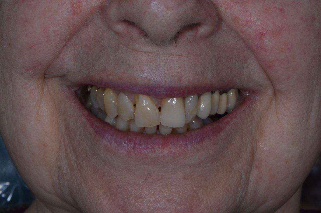 After strengthening a fractured tooth