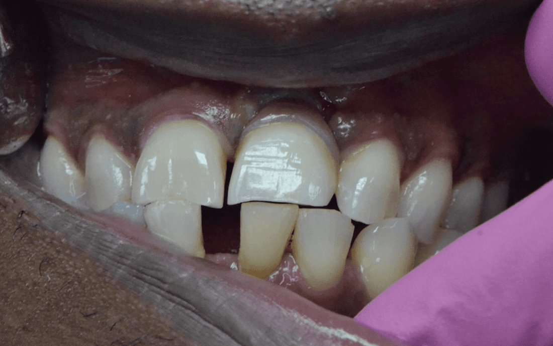 After dental implant