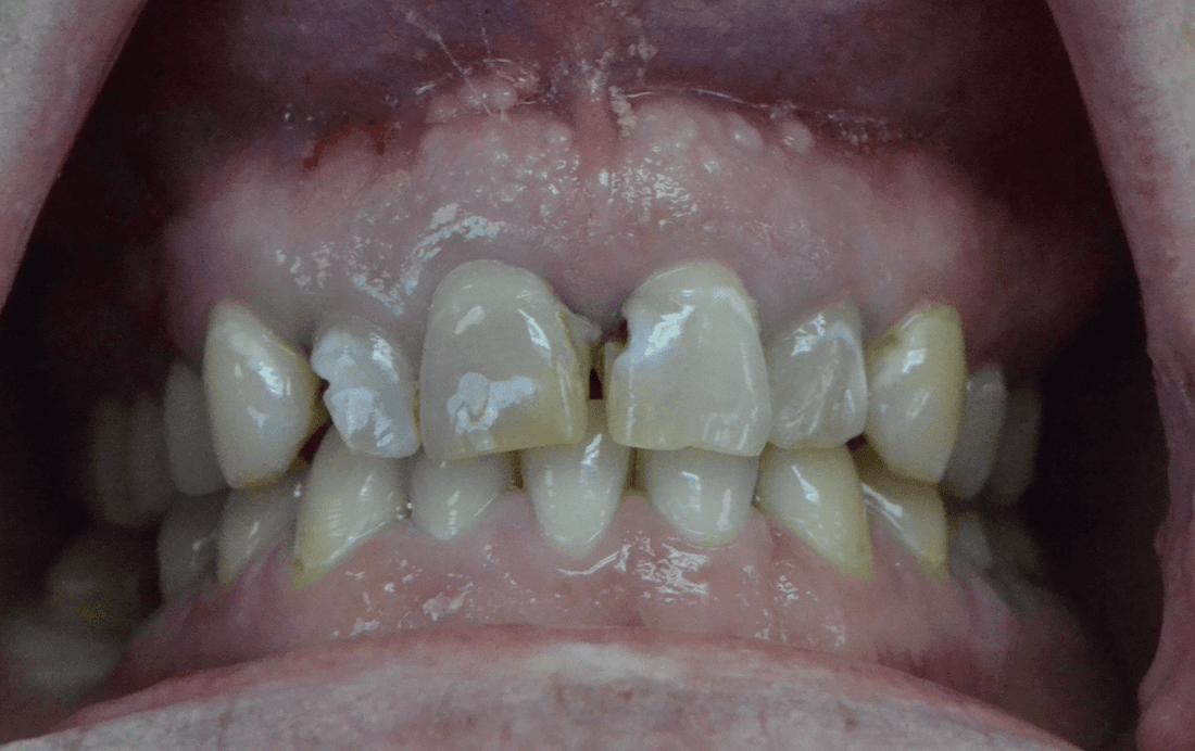 before picture of Crown Treatment & Esthetic Enhancements in Columbia, MD