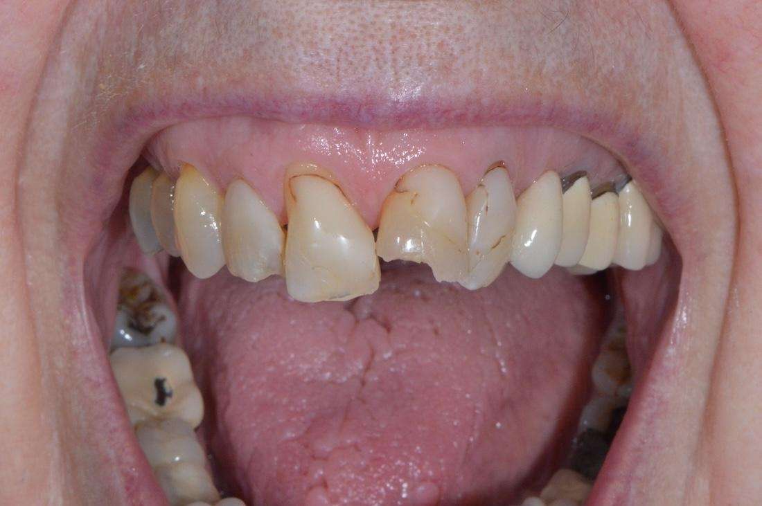 Before strengthening a fractured tooth