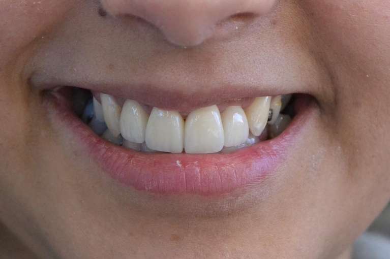 Beautiful-Results-with-Esthetic-Crowns-After-Image