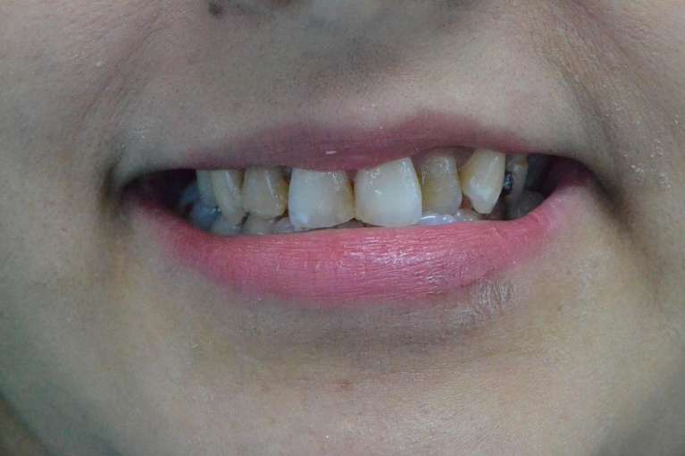 Beautiful-Results-with-Esthetic-Crowns-Before-Image
