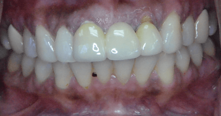 Smile-Makeover-Before-Image