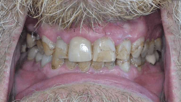 Complete-Smile-Transformation-Before-Image
